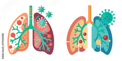 Diseased Lungs with Inflammation — Pneumonia and Infection Vector Illustration