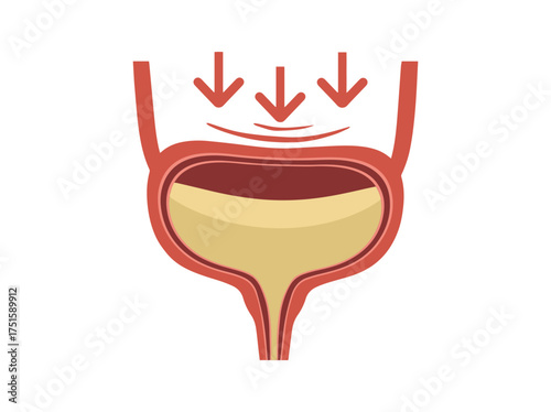Bladder Stress Incontinence Clip Art