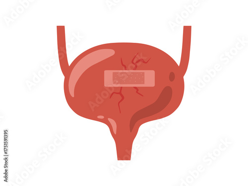 Bladder Disease Clip Art Illustration