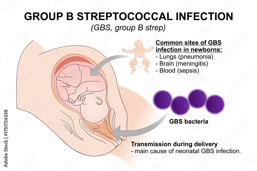 Fototapeta premium Group B streptococcal infection, flashcard medical