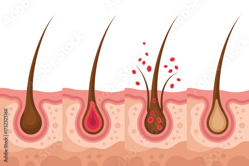 Illustration of hair follicle stages showing growth and loss