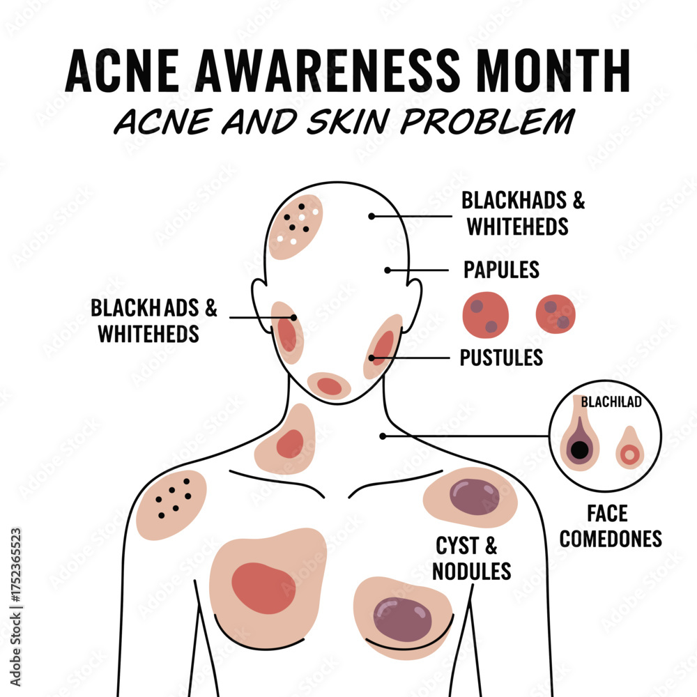 Fototapeta premium During Acne Awareness Month, we address acne and skin issues, including body acne types such as blackheads, whiteheads, papules, pustules, cysts, nodules, and facial comedones