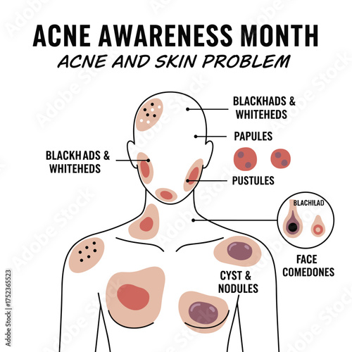 During Acne Awareness Month, we address acne and skin issues, including body acne types such as blackheads, whiteheads, papules, pustules, cysts, nodules, and facial comedones
