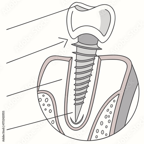 Dental implant graphic, detailed illustration, showcasing screw design and surrounding structures