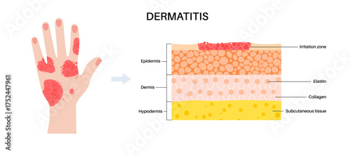 Dermatitis skin disease