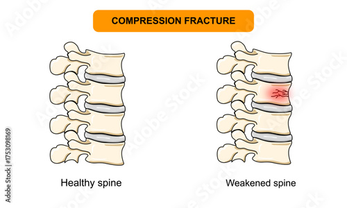 Illustration of a spinal compression fracture. Vertebral compression fracture, back pain, osteoporosis. Vector for medical, clinical, or educational posters.