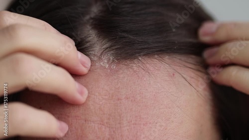 Woman with dandruff on her scalp, closeup. 4K, slow motion.