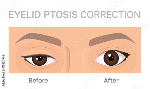 Illustration of eyelid ptosis correction showing before and after transformation.Upper blepharoplasty.Perfect for beauty and medical content.