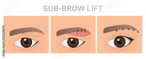 Step-by-Step Guide to Sub-Brow Lift Procedure. Illustration can be used for beauty and medical content.