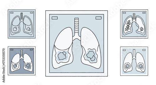 Medical illustrations of lungs with tumors in various stages and x-ray views on a white background.