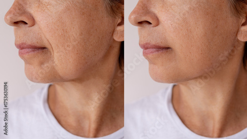 Before and after close-up of a mature woman’s lower face and jawline, showing visible skin improvement, reduced wrinkles and smoother texture. Anti-aging or skincare concept. Facelift, plastic surgery