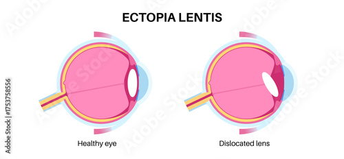 Ectopia lentis disease
