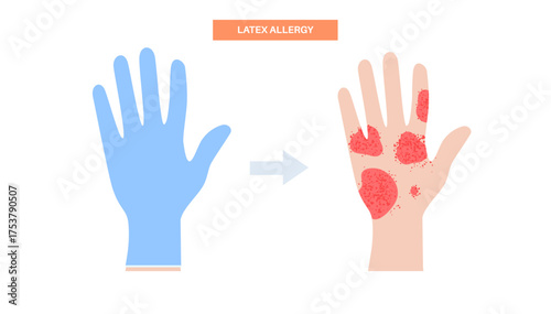 Latex allergy inflammation