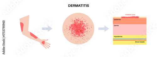 Dermatitis skin disease