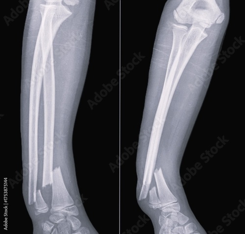 x ray image of distal radius fracture, and ulna fractures, broken hand ,
