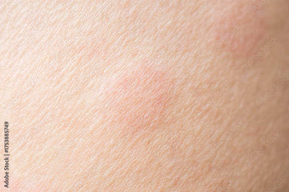 Fototapeta premium Skin allergy rash dermatitis texture close up background