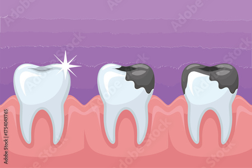 Progression of tooth decay, from healthy to severely damaged, showcasing the importance of dental hygiene and regular checkups for oral health on transparent background