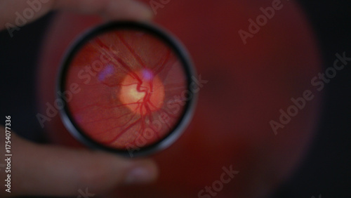 View of optic disc during examination of retina while holding 20 diopter lens. A routine fundus screening method during eye exam.