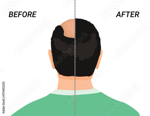 Male head before and after hair transplant or hair loss treatment back view