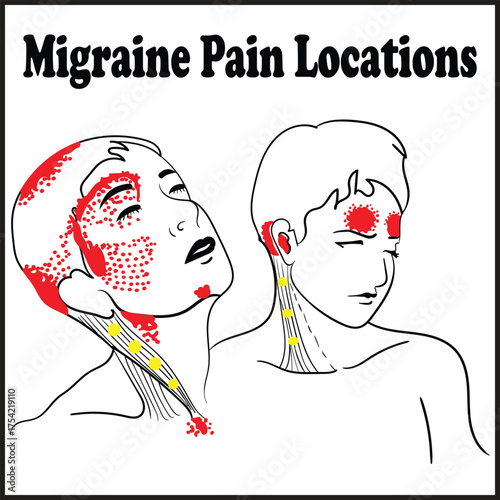 Migraine Pain Locations, Myofascial Trigger Points, and Referred Pain Patterns of the Head