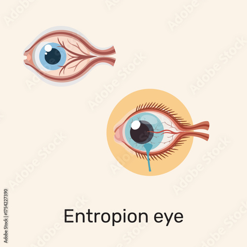 Entropion eye illustration of the eye condition