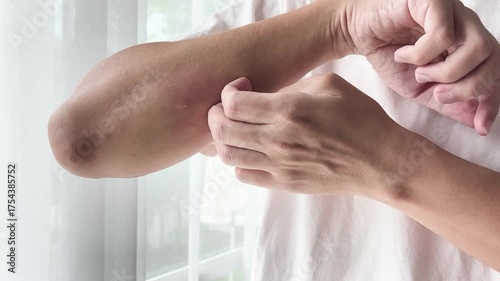 Young asian man itching and scratching on arm from itchy dry skin eczema dermatitis