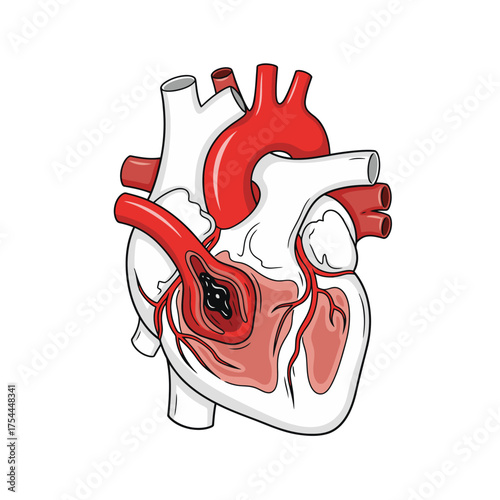 Intricate anatomical heart illustration displaying cardiac arrest for medical study, healthcare awareness, and educational purposes, promoting heart health knowledge9