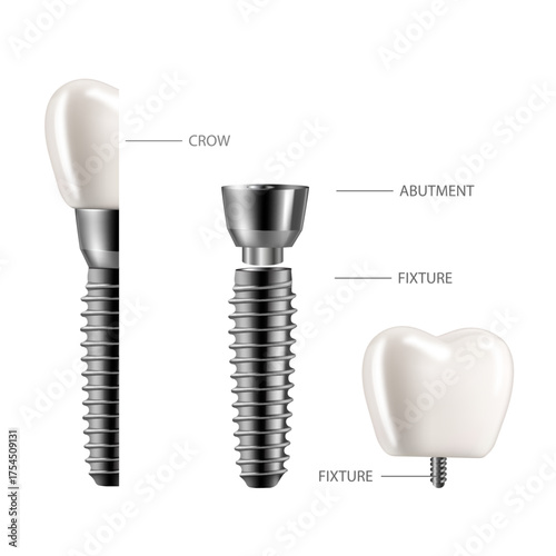Dental implant structure infographic. Realistic 3D illustration with labeled components on white background for medical and educational use.