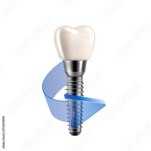 Dental implant with blue arrow. Realistic 3D render on white background for medical and professional use.