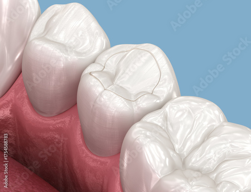 Toth restoration with filling. 3D illustration.