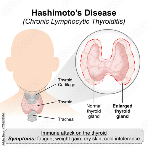 Hashimoto’s Disease (Chronic Lymphocytic Thyroiditis)
