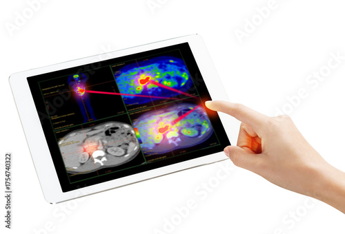 Hand interacting with tablet displaying PET/CT scans. Multiview diagnostic imaging highlights abnormal metabolic activity. Ideal for medical, oncology, and tech-related visuals.
