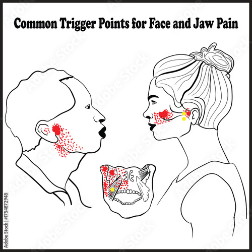 Common Trigger Points for Face and Jaw Pain