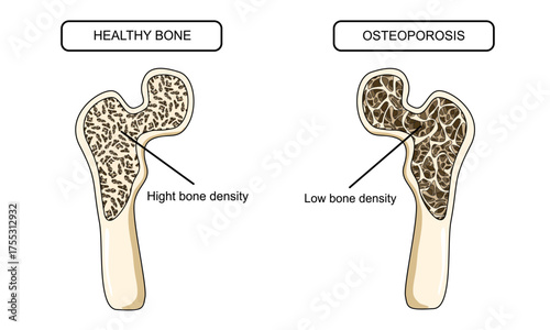 Illustration of osteoporosis and healthy bones. Systemic skeletal disorders, human hip bone, loss of bone mineral density. Risk of fracture. Vector illustration for medical, clinic, and education