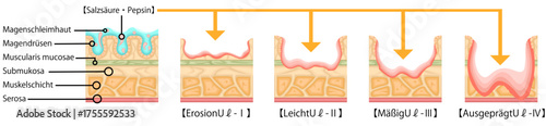 胃潰瘍　重症度　イラスト　ドイツ語