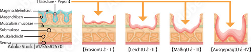 胃潰瘍　重症度　イラスト　ドイツ語
