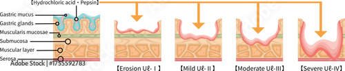胃潰瘍　重症度　イラスト　英語