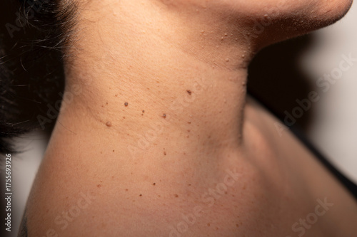Wallpaper Mural Macro shot of neck with multiple skin moles. Torontodigital.ca