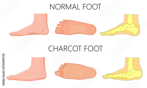 Normal and Charcot foot on a white bacground