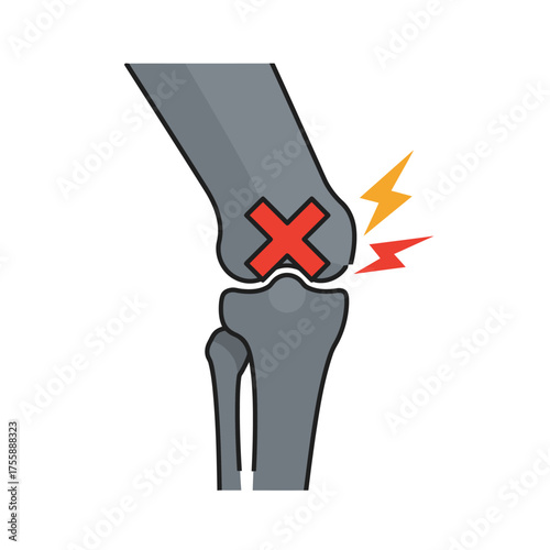 A vector illustration of a knee joint, marked with a red 'X' and lightning bolts, symbolizing acute pain, injury, or a severe orthopedic condition.