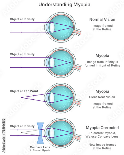 Myopia Explained with Infographic on Normal Vision and Corrective Concave Lens Solutions