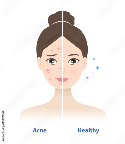 Comparison of acne and healthy skin on woman face vector illustration. The woman with pimple, blackheads, whiteheads, red bumps, pustules, inflamed acne. Before and after treatment concept.