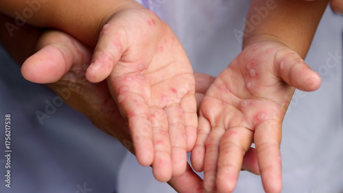 Hand, foot and mouth disease HFMD Human hand of scarlet fever in coxsackievirus palmarosa virus and child hand on white background