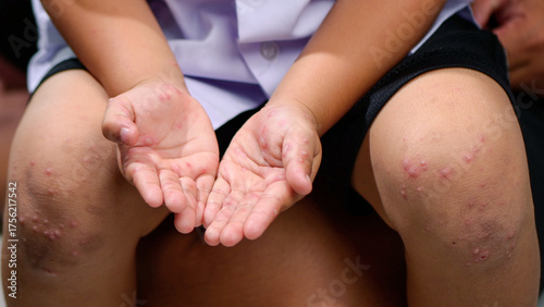 Hand, foot and mouth disease HFMD Human hand of scarlet fever in coxsackievirus palmarosa virus and child hand on white background