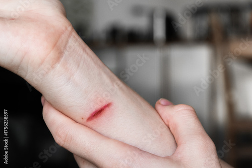 A close-up of a pale arm with a fresh burn mark. The skin shows a red line indicating injury. The background is blurred.