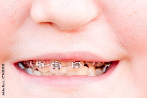 Fotografie A girl with a cleft palate undergoing bite correction with braces, close-up