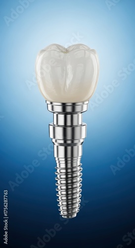Modern Dental Implant System for Tooth Replacement Procedure