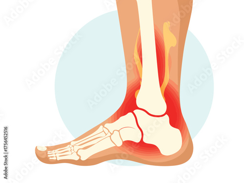 Illustration of inflamed ankle joint and foot bones with pain highlighted in red