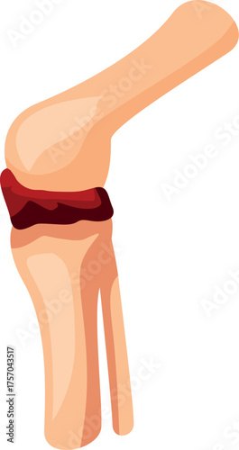Knee joint injury causing inflammation and pain, concept of arthritis, osteoarthritis, and other joint problems