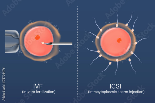 In Vitro Fertilization-IVF and Intracytoplasmic sperm injection-ICSI. Fertility treatment. Assisted reproductive technology in fertility treatment.